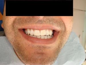 After — bleaching