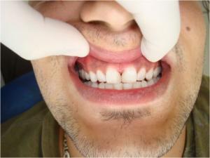 After — bleaching +