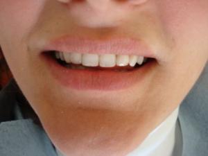 After — bleaching + 3 crowns