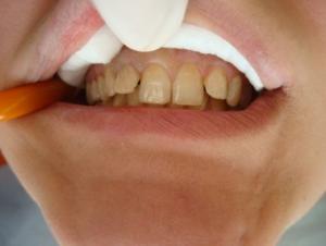 Before — bleaching + 3 crowns